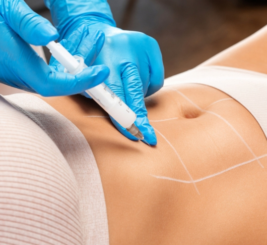 Non-surgical Fat Dissolving Treatment and syringe injecting into carefully marked abdominal fat deposit area