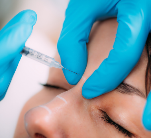 Toxin injections to smooth nasal bunny lines